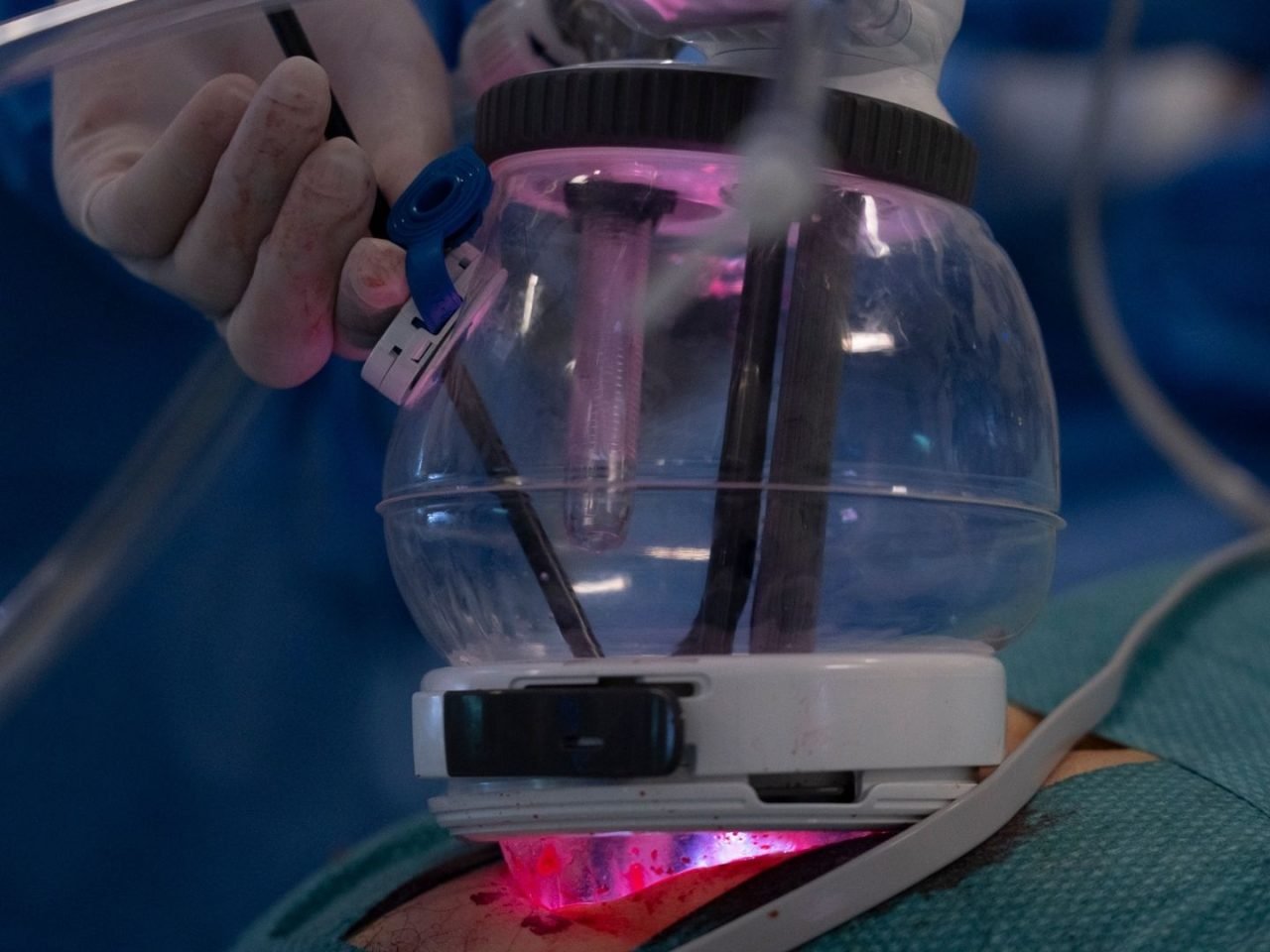 Un hospital español logra el primer trasplante renal robótico de Europa con una incisión de 7 centímetros